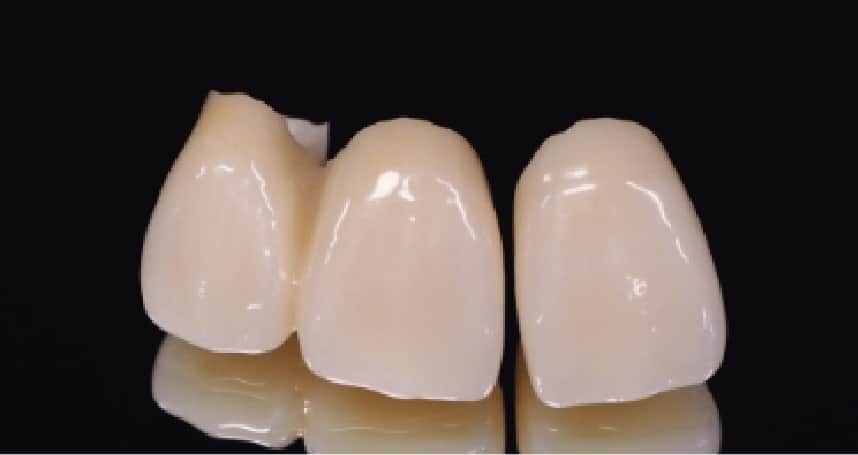 Dental crown<br>Milling by CAD/CAM milling machines